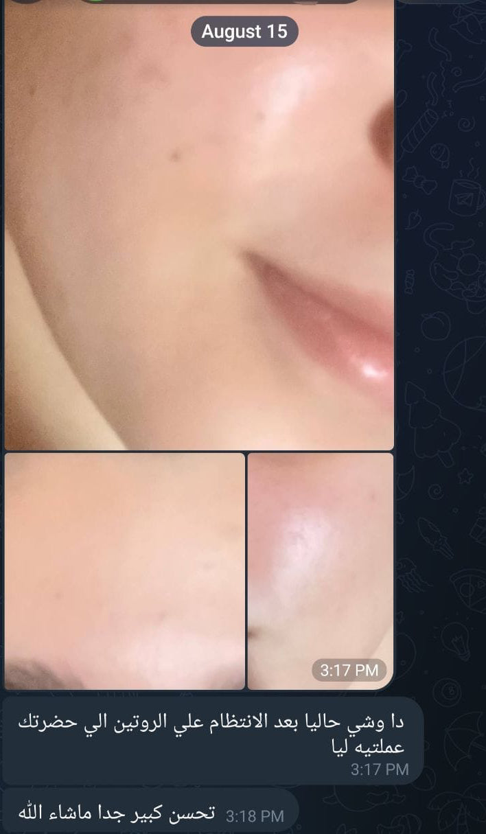 Gold Acne Kit | مجموعة الحبوب المتقدمة