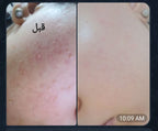 Gold Acne Kit | مجموعة الحبوب المتقدمة