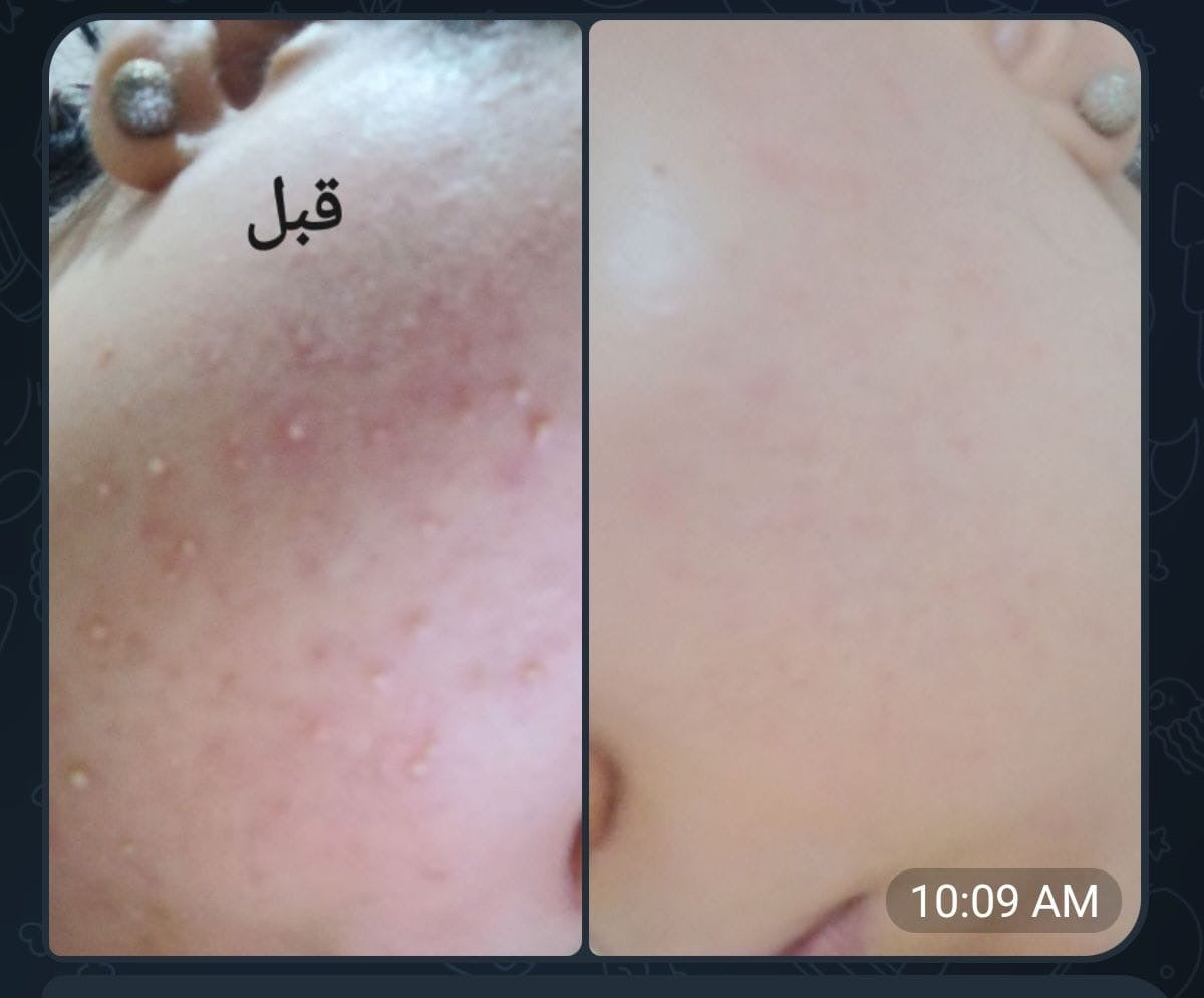 Gold Acne Kit | مجموعة الحبوب المتقدمة