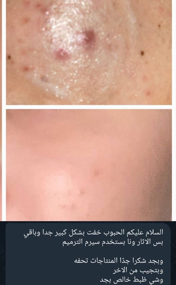 Gold Acne Kit | مجموعة الحبوب المتقدمة